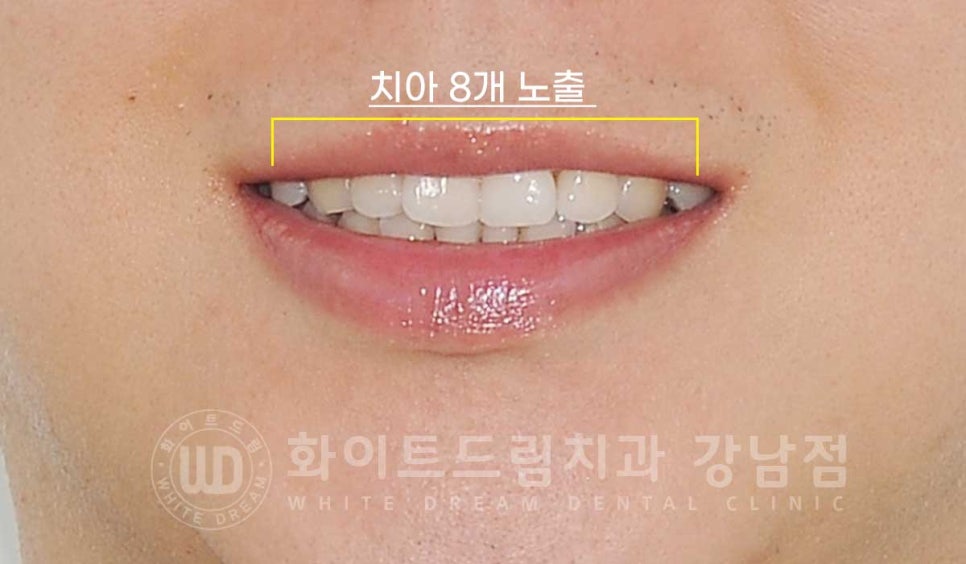 틀어진 치아 라미네이트, 틀어지고 색이 다른 앞니가 고민이에요. 관련 이미지 6