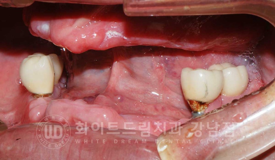 Gangnam Station Dental Clinic Specializing in Implant Revision Surgery—Revision Surgery and Full-Mouth Implant Treatment at the Same Time! image 2