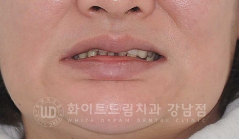 치주염 전체임플란트 치료 사례 / 치아를 흔들리게 만드는 치주염이란? 관련 이미지 3