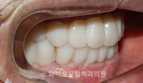 서울전체임플란트잘하는치과, 왜 치주염이 심해지면 반대교합까지 생길까요? (치주염 전체 임플란트 CASE) 관련 이미지 24