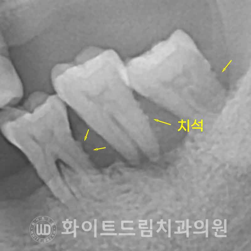 서울전체임플란트 / "경상도에서 왔어요." 치주염으로 인한 앞니 돌출 치료 (+서울전체임플란트 내원 횟수는?) 관련 이미지 2