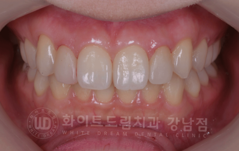 강남역 심미치과 "치아 하나가 유난히 작아요" #왜소치라미네이트 관련 이미지 5
