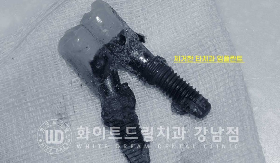 치주염 전체임플란트 치료 사례 / 치아를 흔들리게 만드는 치주염이란? 관련 이미지 2