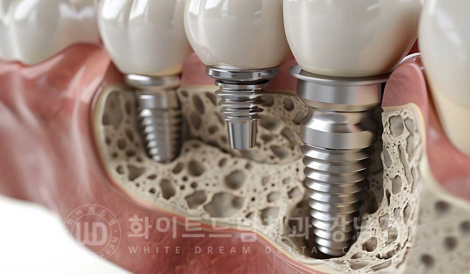 임플란트 1차 수술, 2차 수술이란 무엇일까? (+ 상악 전체 임플란트 치료 기간) 관련 이미지 9