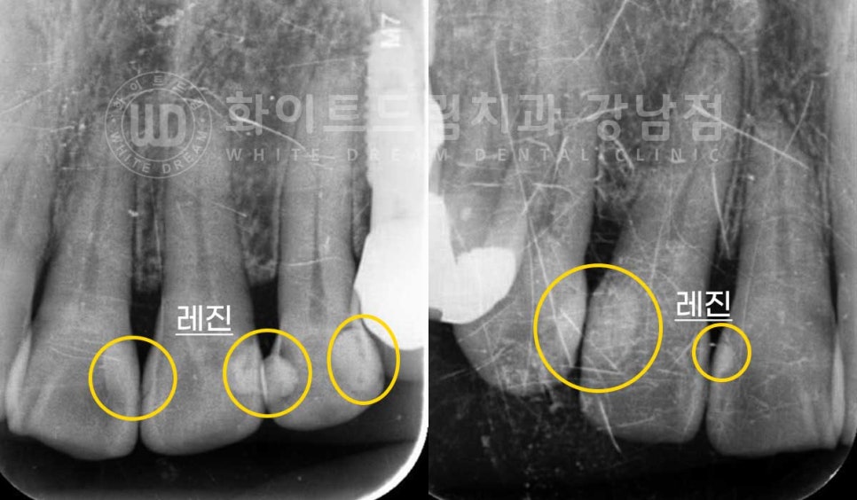 노화된 치아 라미네이트 / 치아미백을 해도 하얘지지 않는 마모된 치아는 어떻게 할까? 관련 이미지 8