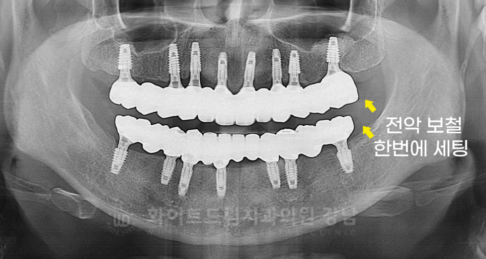 강남역 임플란트 치과 "틀니가 안 맞아서 불편해요" 틀니 → 전체 임플란트로! 관련 이미지 19