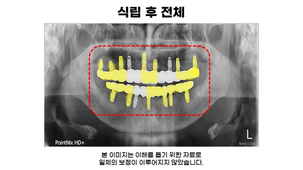 어금니임플란트 수복 및 당뇨환자임플란트 가격, 종류, 통증 관련 이미지 15