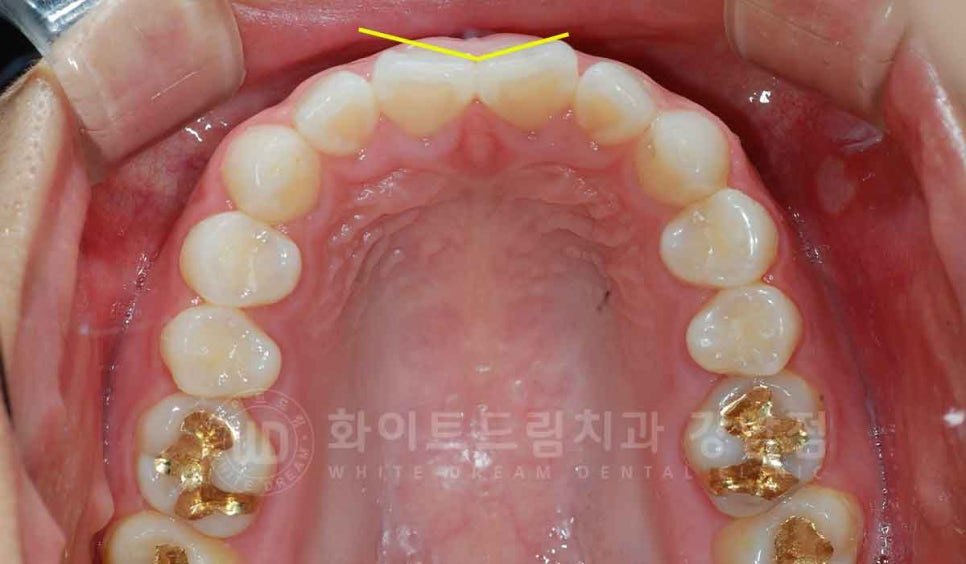 강남역 나비앞니 라미네이트 / "투명교정과 라미네이트 치료" 강남역 화이트드림치과 관련 이미지 2