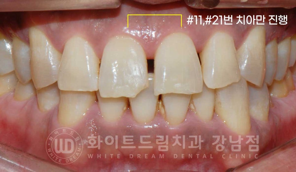 벌어지고 깨진 앞니, 웨딩 앞니 라미네이트 치료 사례 "남자도 자연스럽게 라미네이트 가능한가요?" 관련 이미지 10