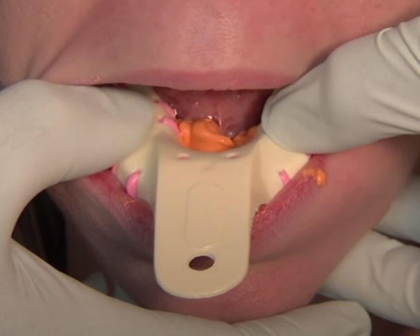 임플란트 하기 전 알아보아야 할 것. 관련 이미지 9