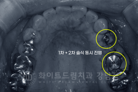 강남역 어금니 임플란트 "어금니가 부러졌어요" 상악동 거상술(lateral approach) 관련 이미지 8