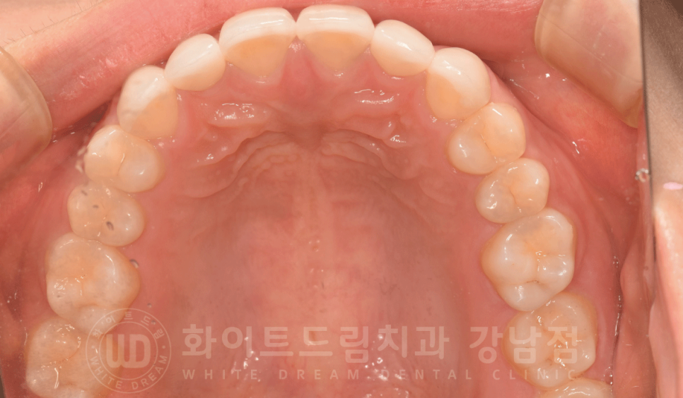 강남 벌어진앞니 교정 / "심하게 벌어진 치아, 어떻게?" 부분교정 + 라미네이트로 개선! 관련 이미지 20