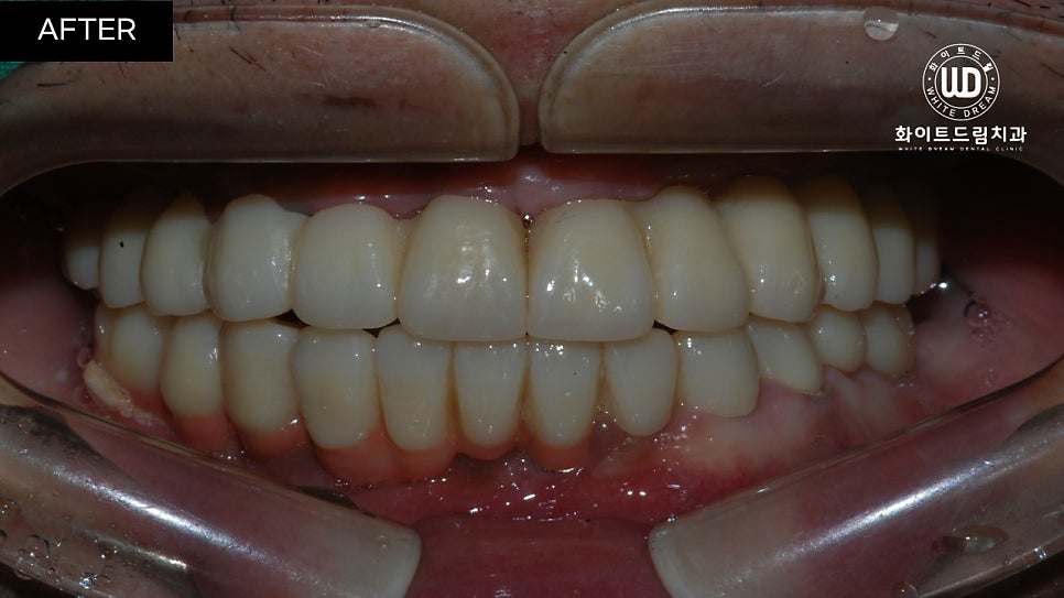 전체임플란트 식립 및 임플란트뼈이식 후기 관련 이미지 12