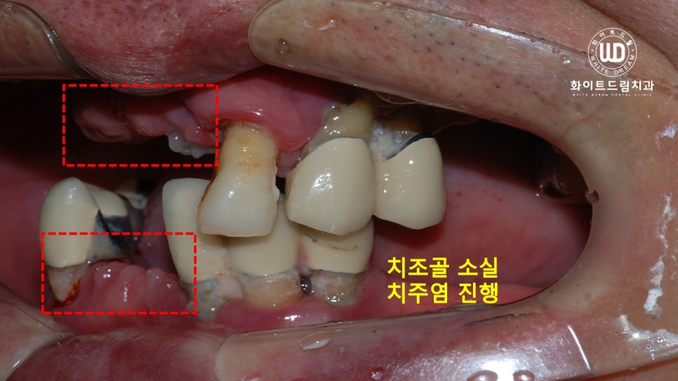무너진 잇몸뼈와 치아 상실을 대체하는 전악임플란트 치료 사례 관련 이미지 1