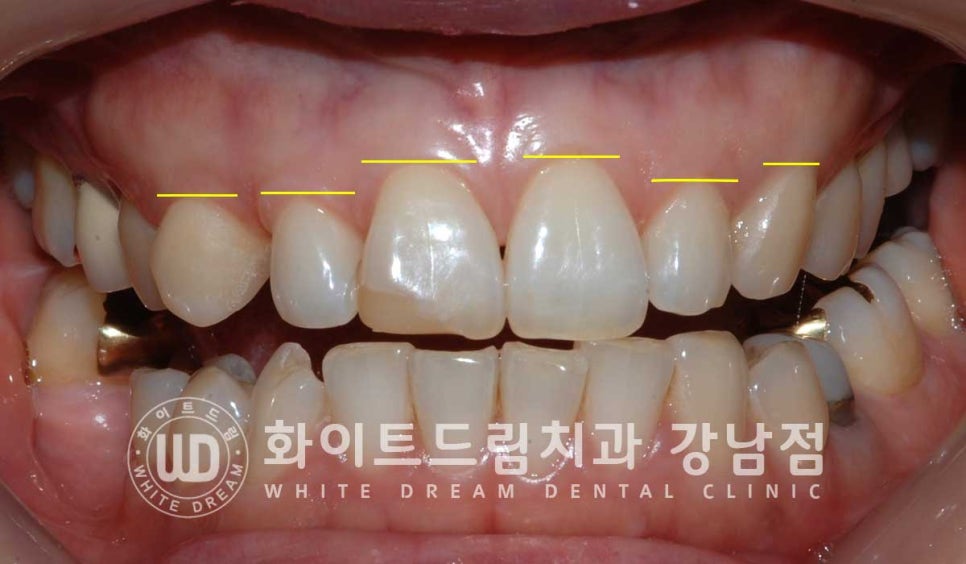 앞니 원데이라미네이트, 뻐드러지고 벌어진 앞니! 당일 치료 ok 관련 이미지 15