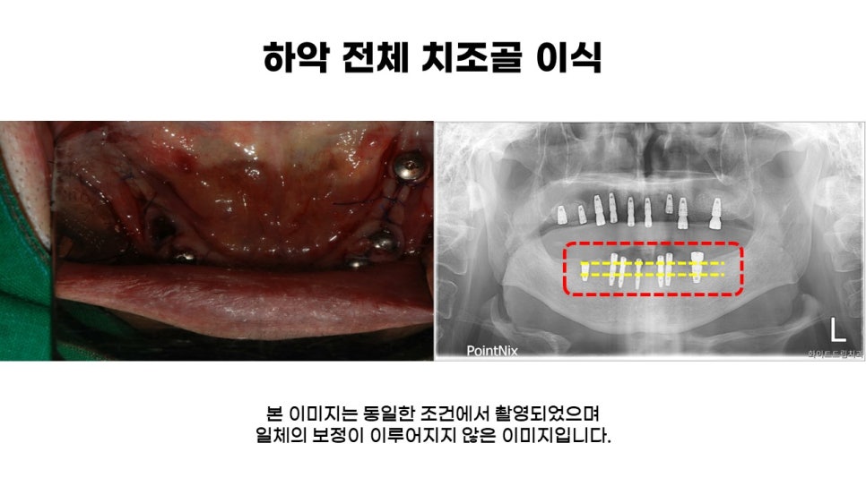 어금니임플란트 수복 및 당뇨환자임플란트 가격, 종류, 통증 관련 이미지 8