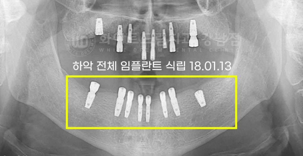 강남역 전악 임플란트 "치아가 흔들리고 빠져요!" 치주염 임플란트 치료 관련 이미지 8