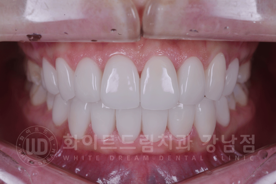 강남역 원데이 라미네이트 "유튜브 촬영하는데 치아가 신경 쓰여요" #강남화이트드림치과 관련 이미지 15