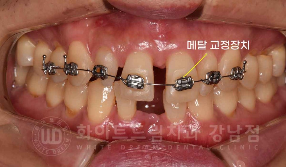 강남역 결손치 "앞니 두 개가 없고, 벌어졌어요" 결손치 치료 방법 관련 이미지 7