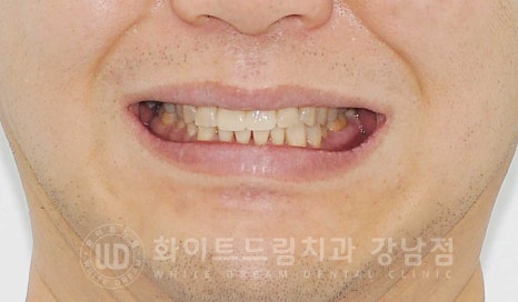 벌어지고 깨진 앞니, 웨딩 앞니 라미네이트 치료 사례 "남자도 자연스럽게 라미네이트 가능한가요?" 관련 이미지 3