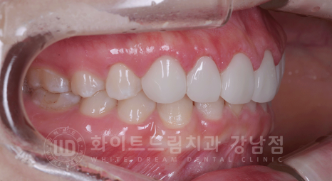 강남역 라미네이트 "치아가 작고 벌어졌어요" 거미스마일 + 벌어진 치아 개선 관련 이미지 5