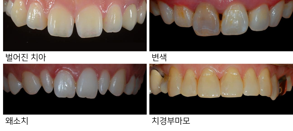 라미네이트 치료에 대해 알아보면? 관련 이미지 15
