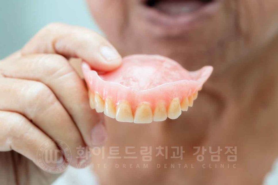 전체임플란트 치료기간 / "전체 임플란트 6개월 완성" (feat. 부분 틀니 10년 사용) 관련 이미지 2