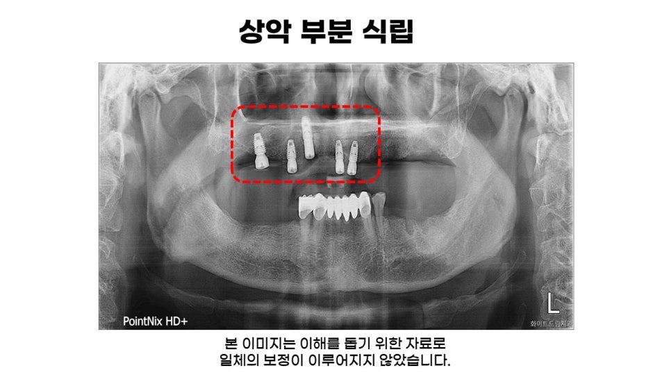 60대 전악임플란트후기 및 치료기간 관련 이미지 4