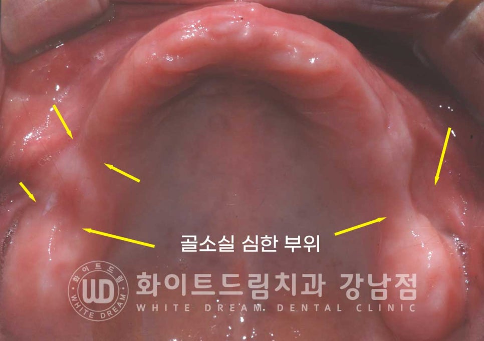 상악 풀케이스임플란트 사례 "부산에서 강남까지 왔어요" 관련 이미지 7