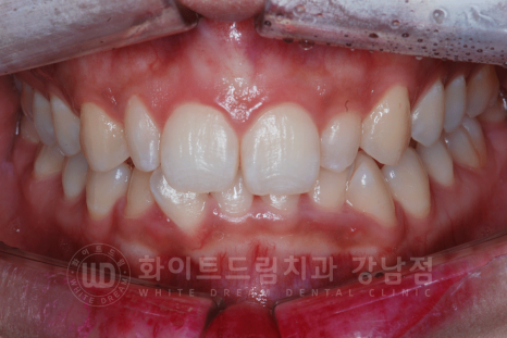 신논현역 라미네이트 / 과개교합 치아교정 + 왜소치 라미네이트 진행 case 관련 이미지 9