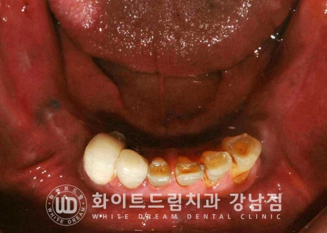임플란트 개수를 줄일 수 있는 방법? (+치아를 발치한지 오래되었나요?) 관련 이미지 7