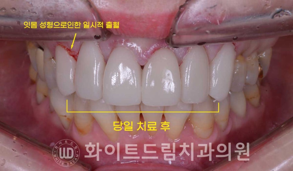 신논현라미네이트, 중년 충치치료, "치경부 우식증, 라미네이트로 당일 치료 OK" 관련 이미지 11