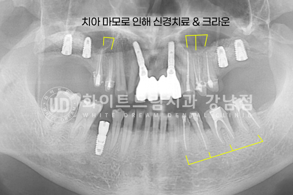 강남역 임플란트치과 / "어금니가 없고 이갈이가 심해요" 강남역 화이트드림치과 관련 이미지 10