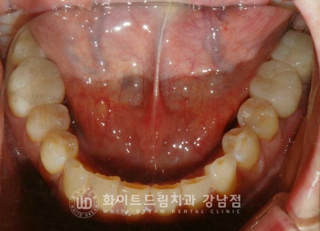 신경치료 후 크라운을 해야 하는 이유 / 크라운을 안 해 부러진 치아 임플란트 치료 case 관련 이미지 20