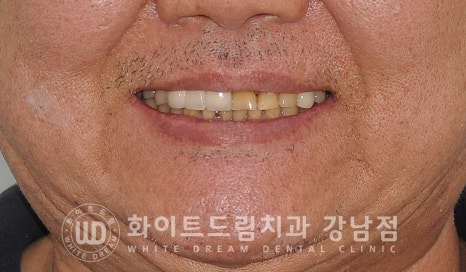 앞니 충치 라미네이트 치료 / "옆 크라운과 치아 색상을 맞추고 싶어요" 관련 이미지 11