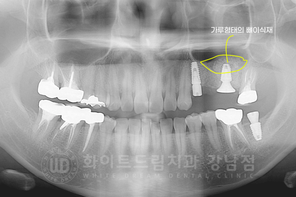 강남역 어금니 임플란트 "어금니가 부러졌어요" 상악동 거상술(lateral approach) 관련 이미지 7