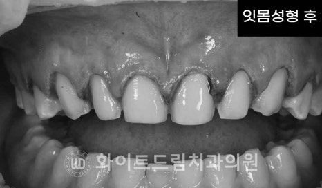 강남역 잇몸성형, 라미네이트와 흔히 동반되는 관련 이미지 8
