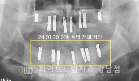전체 임플란트 치료 기간과 수술 후 나타나는 변화는? 관련 이미지 9