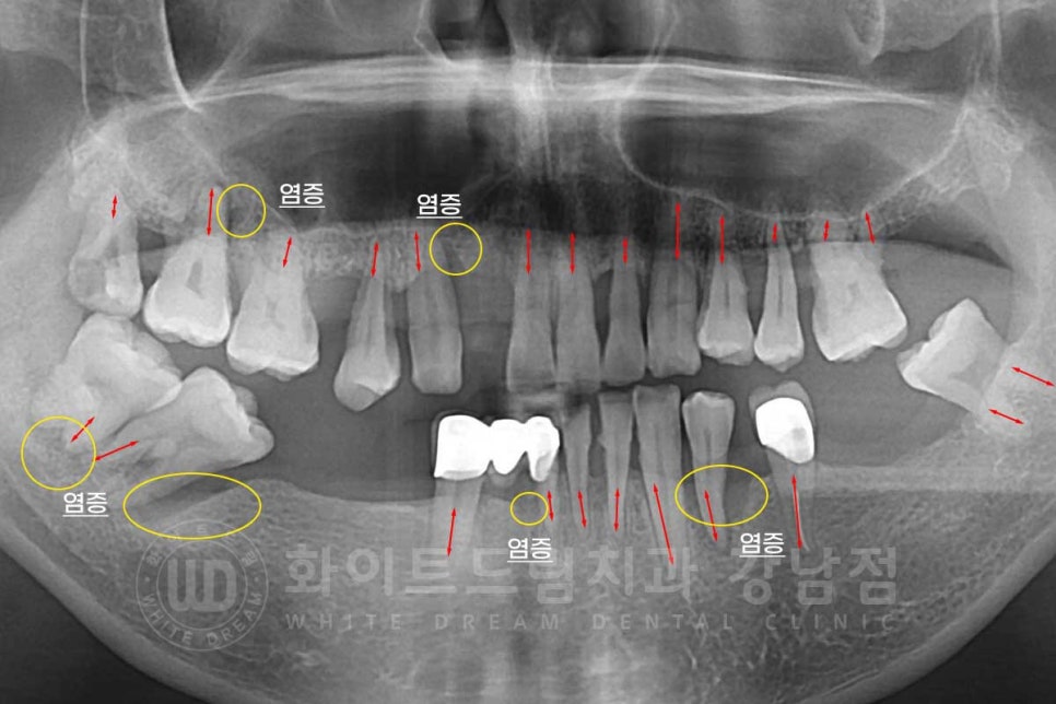 상악동거상술 잘하는치과, 강남역 화이트드림치과 상악동 함기화로 인한 거상술 치료 리뷰 관련 이미지 6