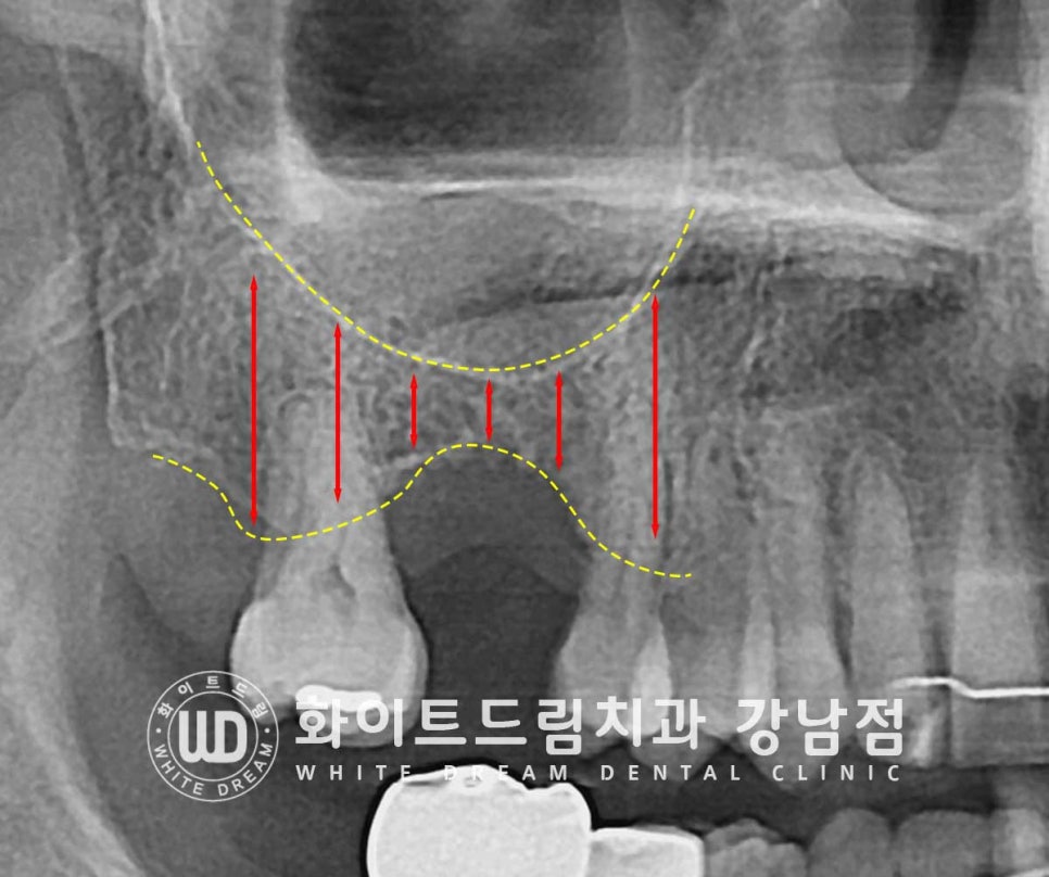 상악 어금니 임플란트 치료 시 동반되는 "상악동 거상술" 이란? 관련 이미지 3