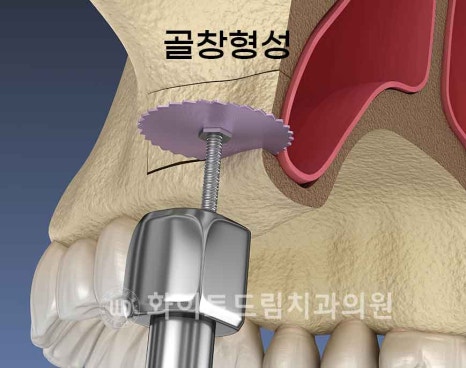 강남역어금니임플란트 치료 시 흔히 동반되는 상악동거상술 (Lateral window 방식), "잘 됐는지 어떻게 확인하죠?" 관련 이미지 9