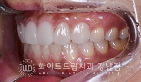 깨진앞니 라미네이트 / 깨지고 누렇게 변한 앞니는? 원데이 라미네이트 치료 사례 관련 이미지 15