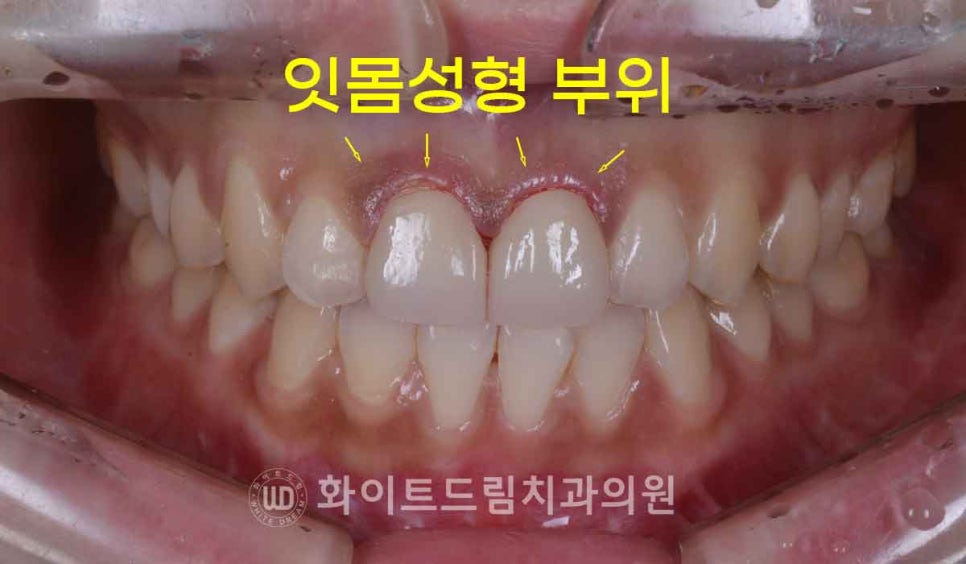 강남역앞니치과 / "신경치료한 치아가 누렇게 변했어요." 신경치료 후 변색된 치아, 어떻게 치료하나요? 관련 이미지 11