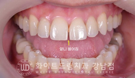 앞니 뻐드러짐 라미네이트 "뻐드러지고 벌어진 앞니" 당일 라미네이트 치료 case 관련 이미지 8