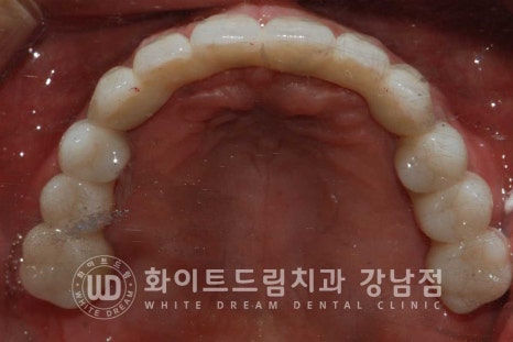 강남역 전악임플란트치과 / 치주 질환이 치아와 임플란트에 끼치는 영향! 관련 이미지 13