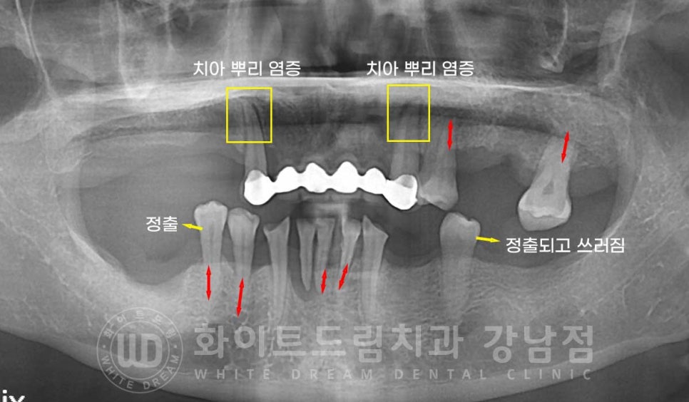 치주염 전체임플란트 치료 사례 / 치아를 흔들리게 만드는 치주염이란? 관련 이미지 8