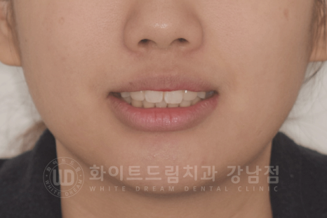 신논현역 라미네이트 / 과개교합 치아교정 + 왜소치 라미네이트 진행 case 관련 이미지 16