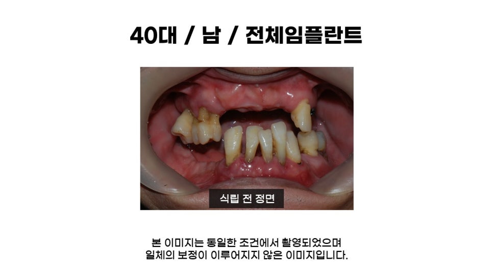 40대임플란트식립후기 및 어금니임플란트 가격, 종류 알아보기 위해 관련 이미지 1