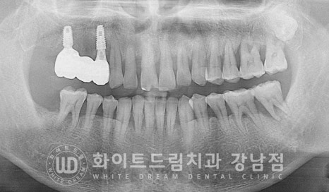 발치 즉시 임플란트 "내원 당일 발치 후 바로 임플란트 식립!" 관련 이미지 5