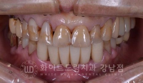 중년 앞니라미네이트 / 노화로 마모되고 누렇게 변한 치아, 어떻게 치료할까? 관련 이미지 3